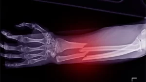fracture treatment in Gaya