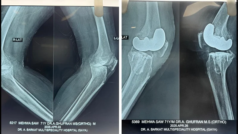 knee replacement before after