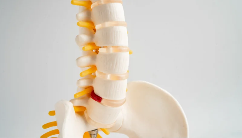 slipped disc