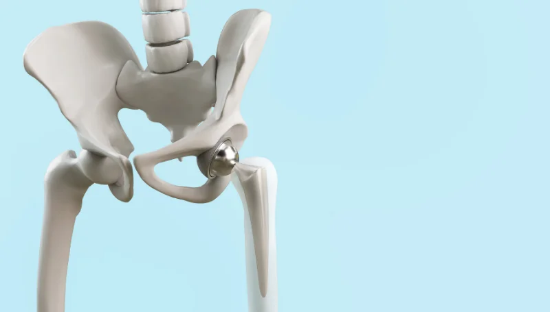hip replacement