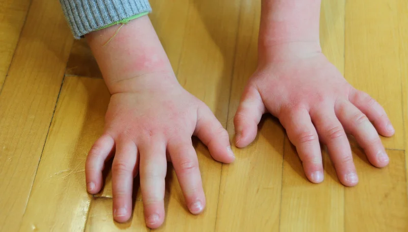 allergy in children