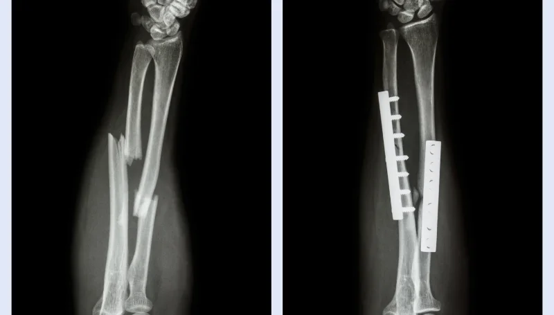 fracture forearm