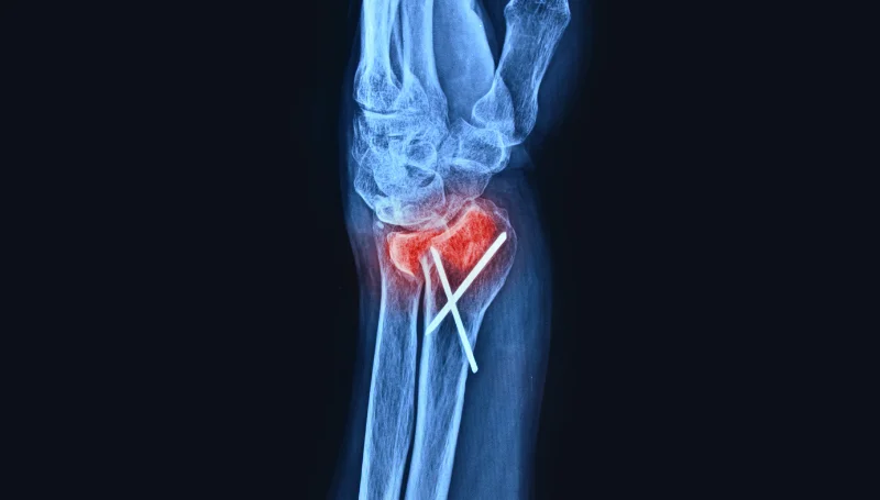 fracture x ray