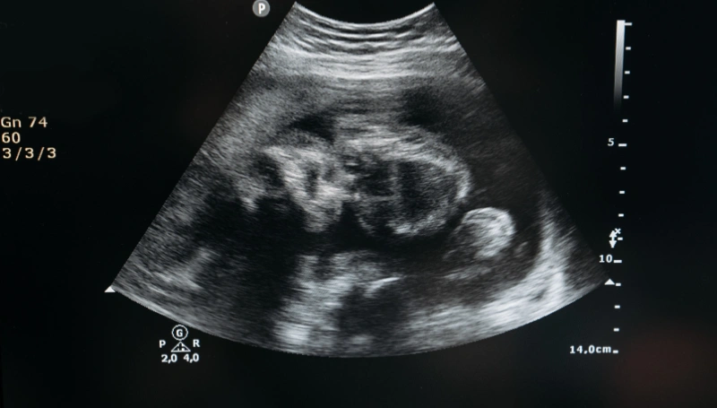 Pregnancy Ultrasound